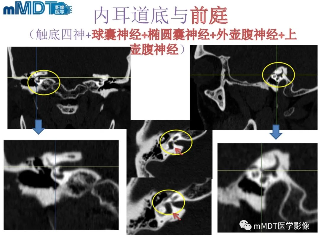 影像PPT - 【PPT】脑神经的影像辨识-66 影像PPT - 【PPT】脑神经的影像辨识-66