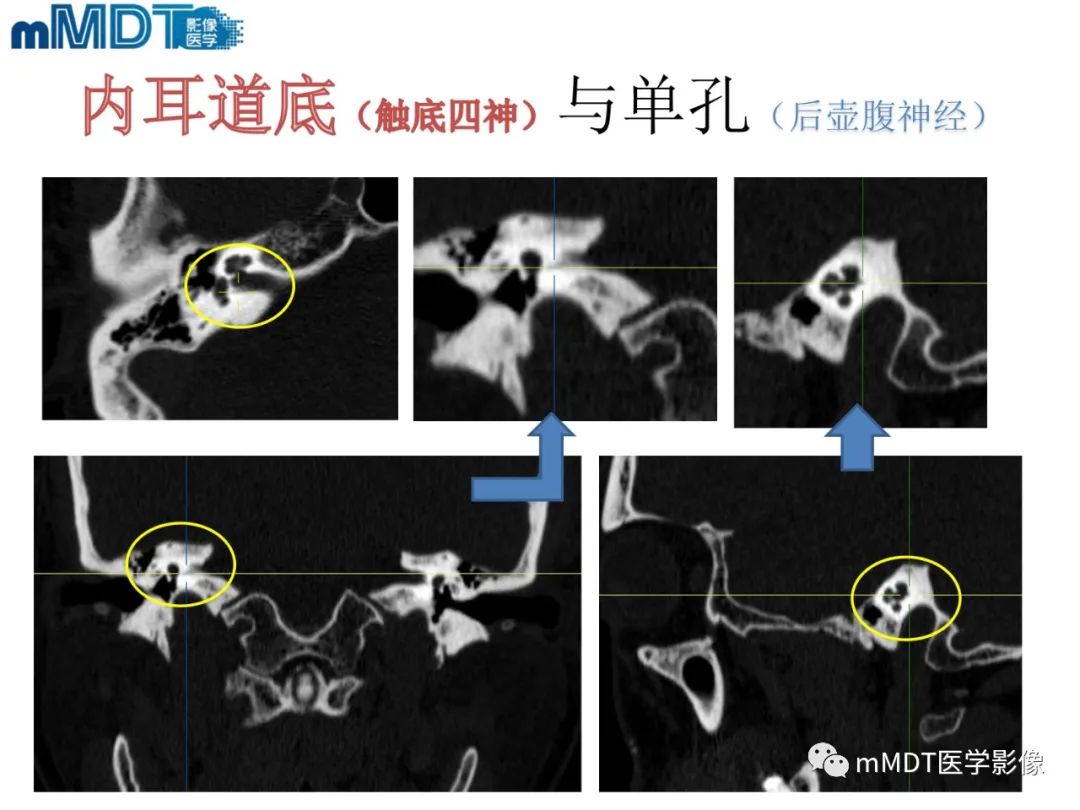 影像PPT - 【PPT】脑神经的影像辨识-67 影像PPT - 【PPT】脑神经的影像辨识-67