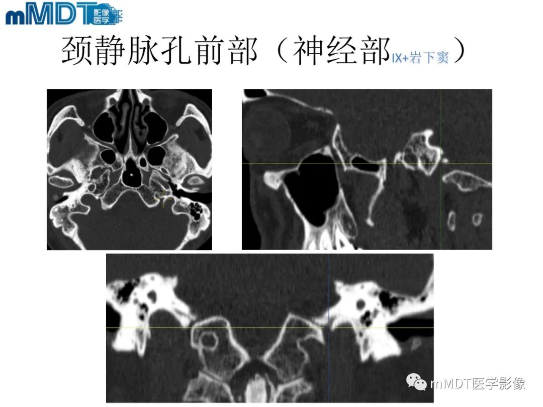 影像PPT - 【PPT】脑神经的影像辨识-69 影像PPT - 【PPT】脑神经的影像辨识-69