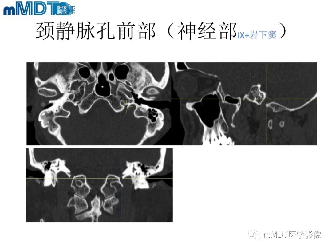 影像PPT - 【PPT】脑神经的影像辨识-68 影像PPT - 【PPT】脑神经的影像辨识-68