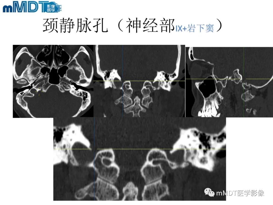 影像PPT - 【PPT】脑神经的影像辨识-70 影像PPT - 【PPT】脑神经的影像辨识-70