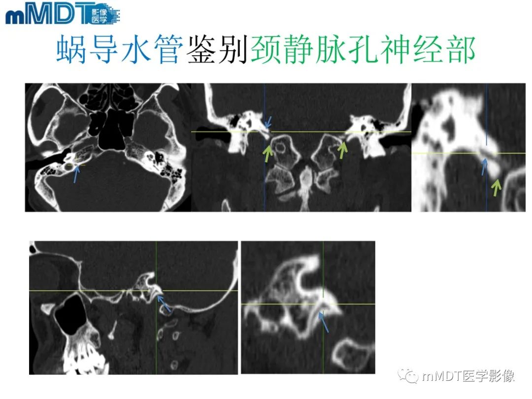 影像PPT - 【PPT】脑神经的影像辨识-71 影像PPT - 【PPT】脑神经的影像辨识-71