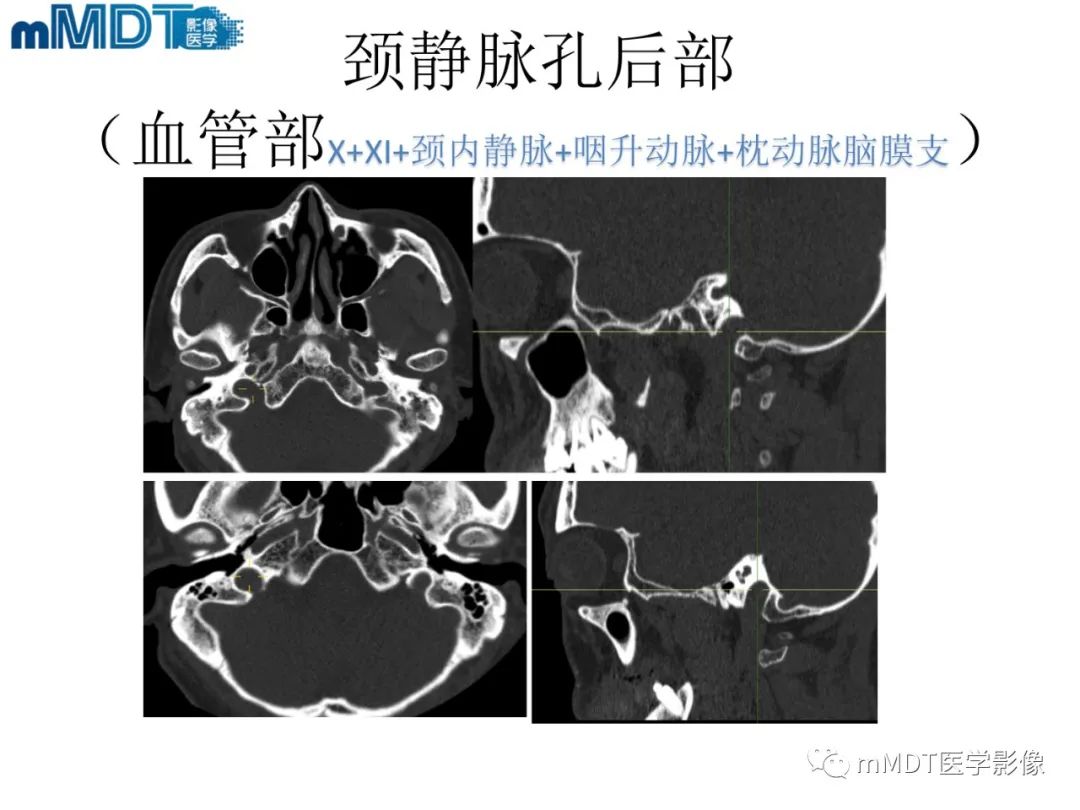 影像PPT - 【PPT】脑神经的影像辨识-72 影像PPT - 【PPT】脑神经的影像辨识-72