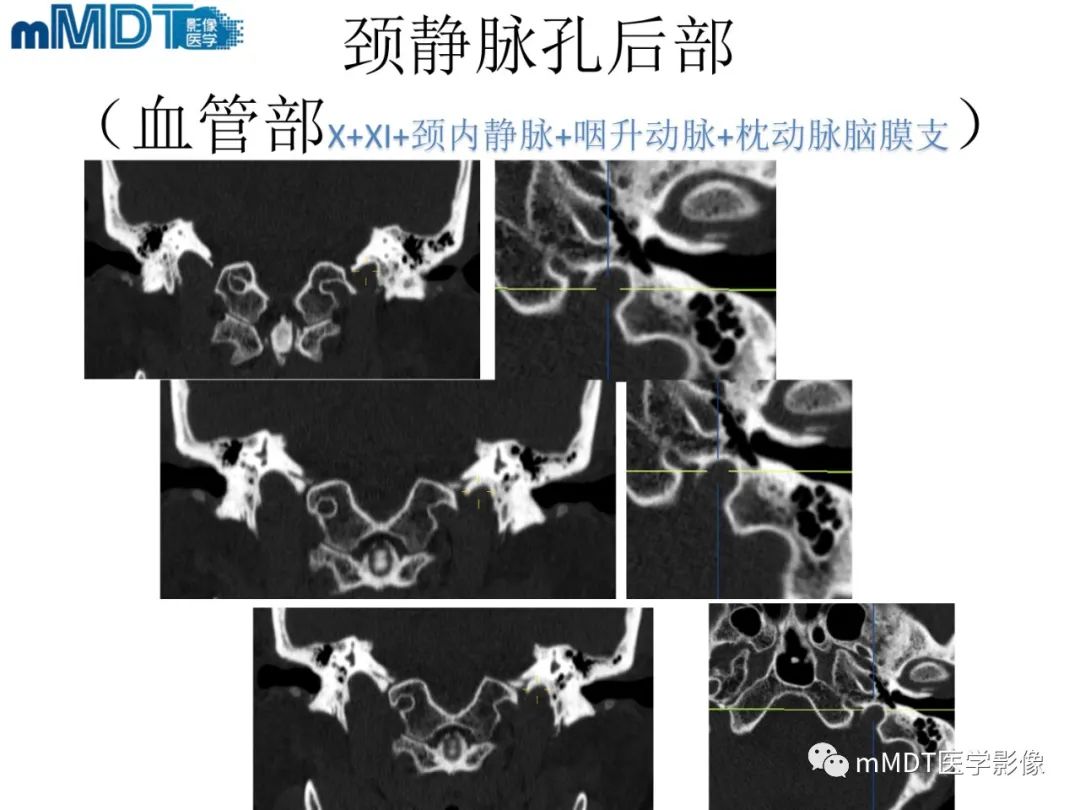 影像PPT - 【PPT】脑神经的影像辨识-73 影像PPT - 【PPT】脑神经的影像辨识-73