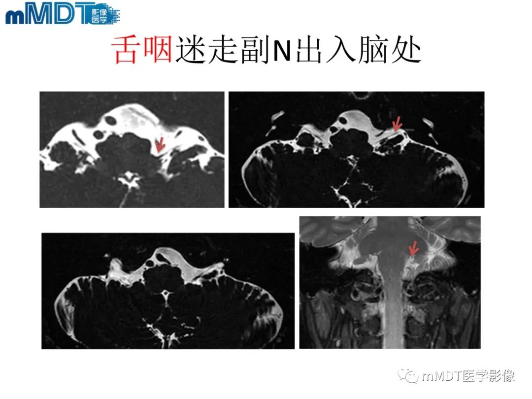 影像PPT - 【PPT】脑神经的影像辨识-74 影像PPT - 【PPT】脑神经的影像辨识-74