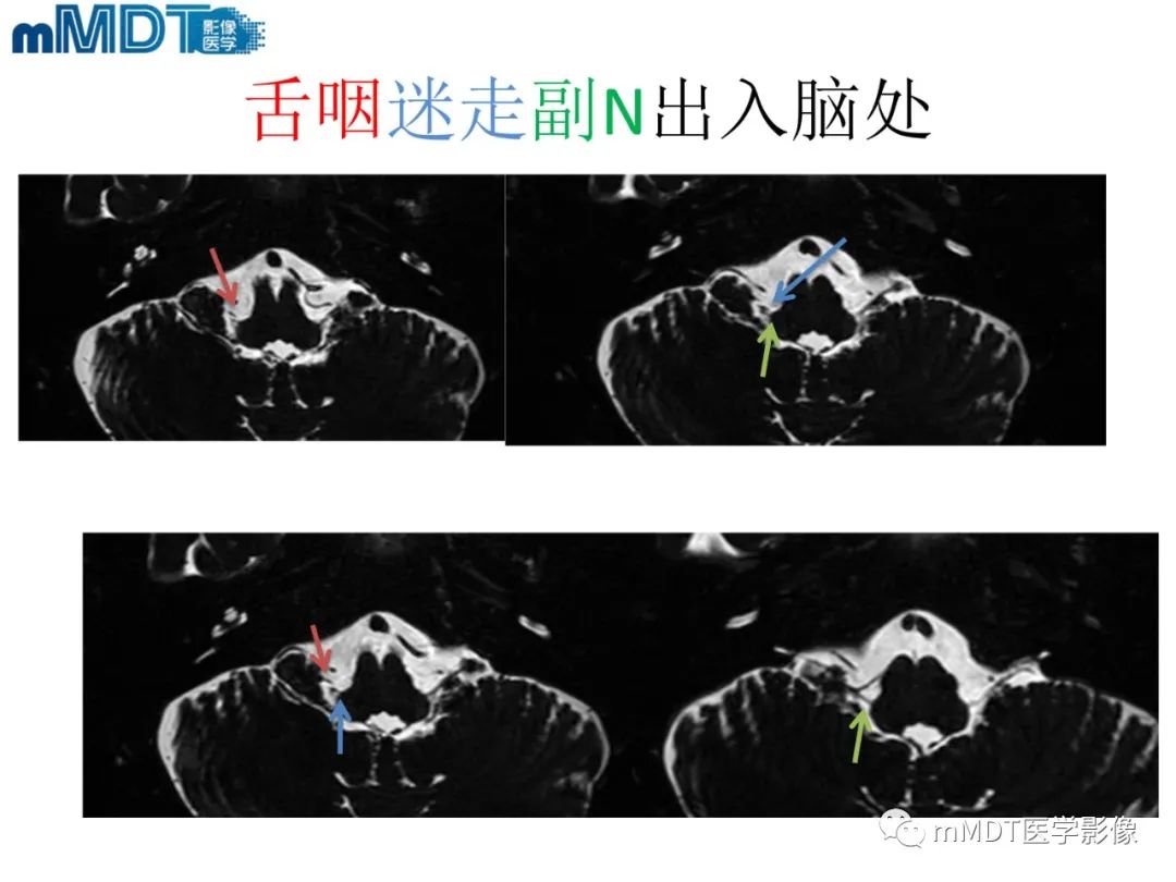 影像PPT - 【PPT】脑神经的影像辨识-75 影像PPT - 【PPT】脑神经的影像辨识-75