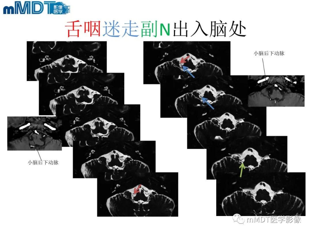 影像PPT - 【PPT】脑神经的影像辨识-76 影像PPT - 【PPT】脑神经的影像辨识-76