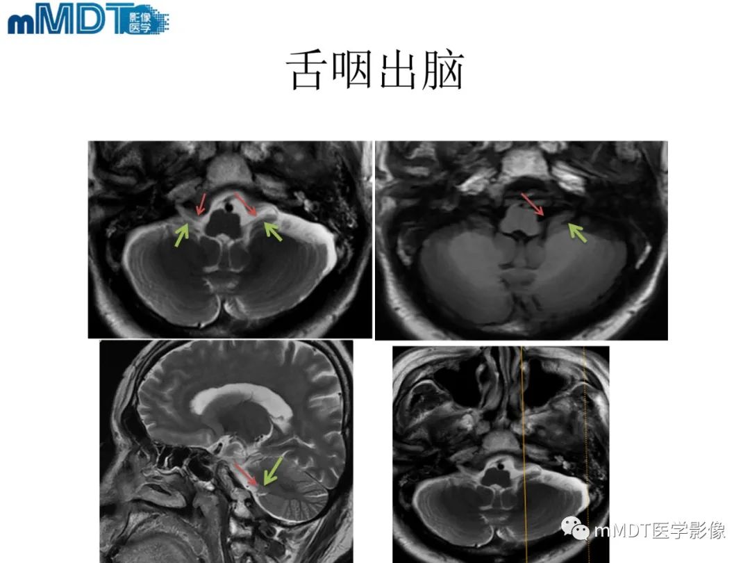 影像PPT - 【PPT】脑神经的影像辨识-77 影像PPT - 【PPT】脑神经的影像辨识-77