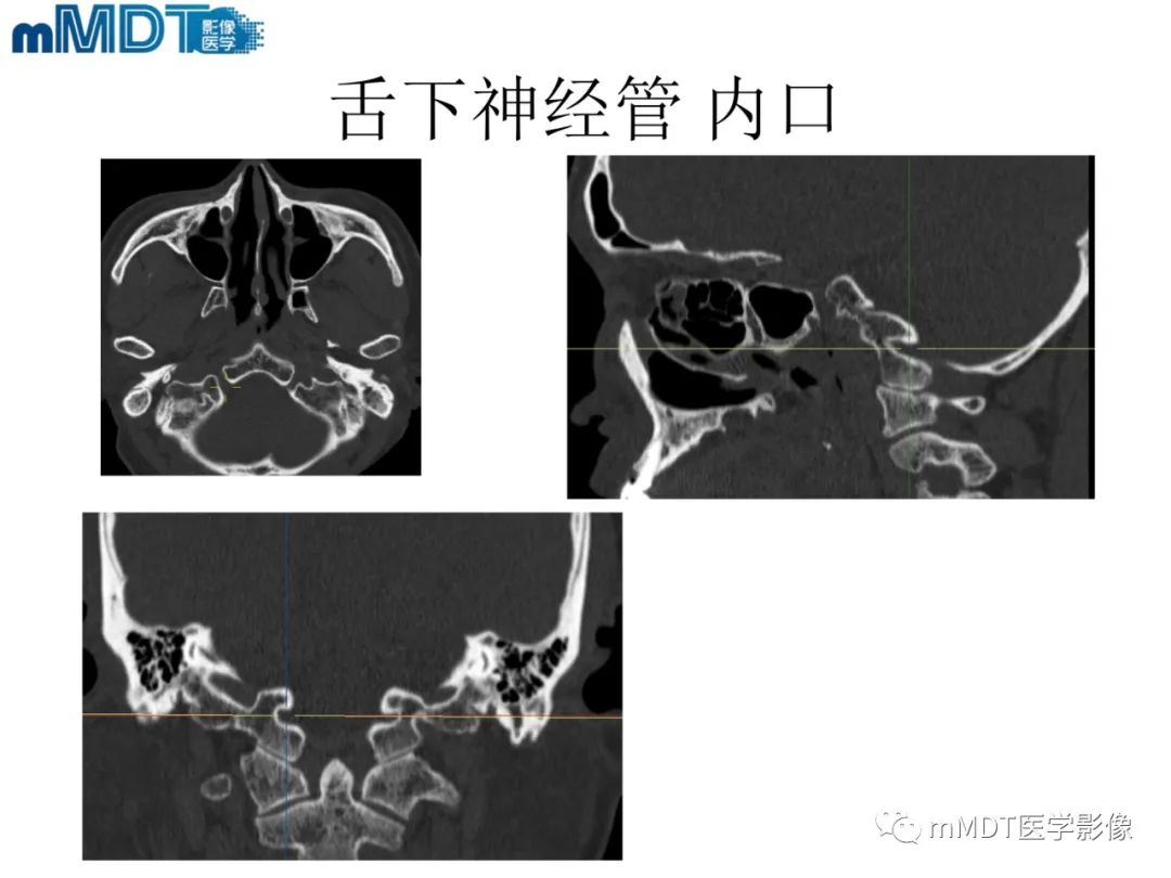 影像PPT - 【PPT】脑神经的影像辨识-78 影像PPT - 【PPT】脑神经的影像辨识-78