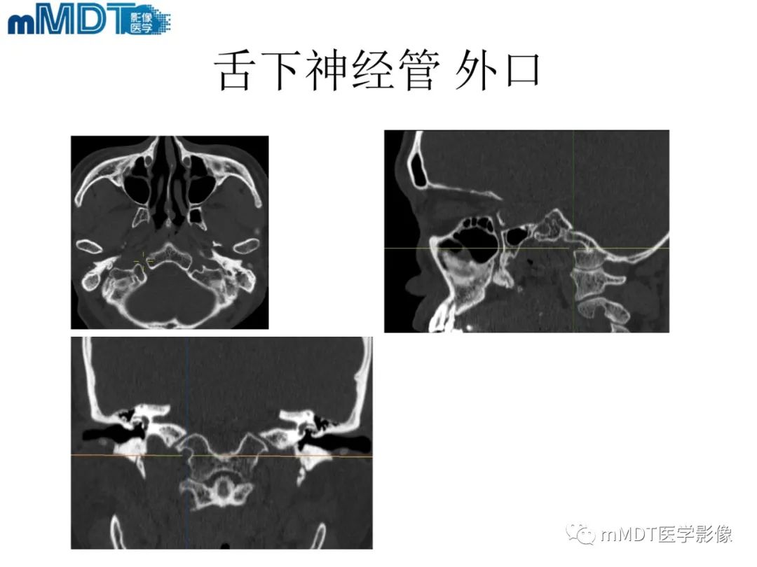 影像PPT - 【PPT】脑神经的影像辨识-79 影像PPT - 【PPT】脑神经的影像辨识-79