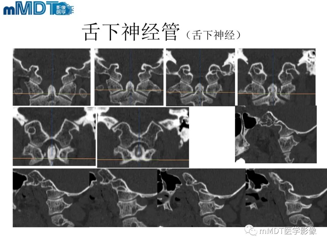影像PPT - 【PPT】脑神经的影像辨识-80 影像PPT - 【PPT】脑神经的影像辨识-80