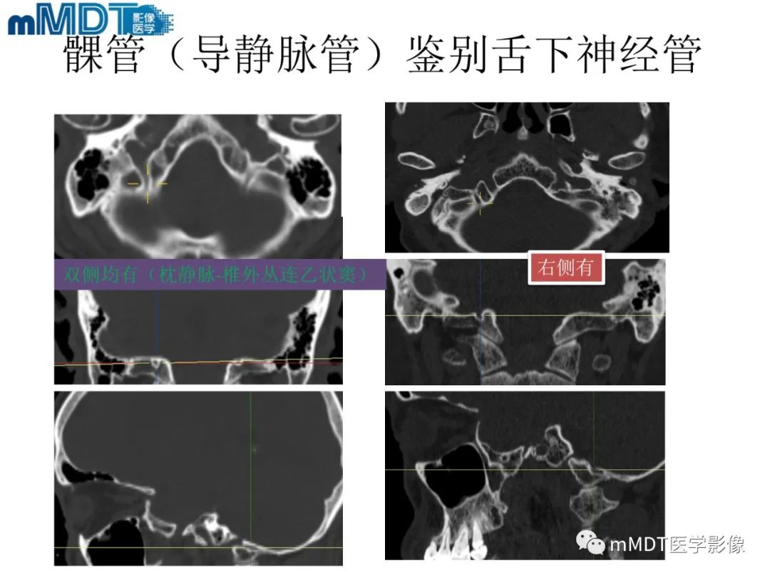 影像PPT - 【PPT】脑神经的影像辨识-81 影像PPT - 【PPT】脑神经的影像辨识-81