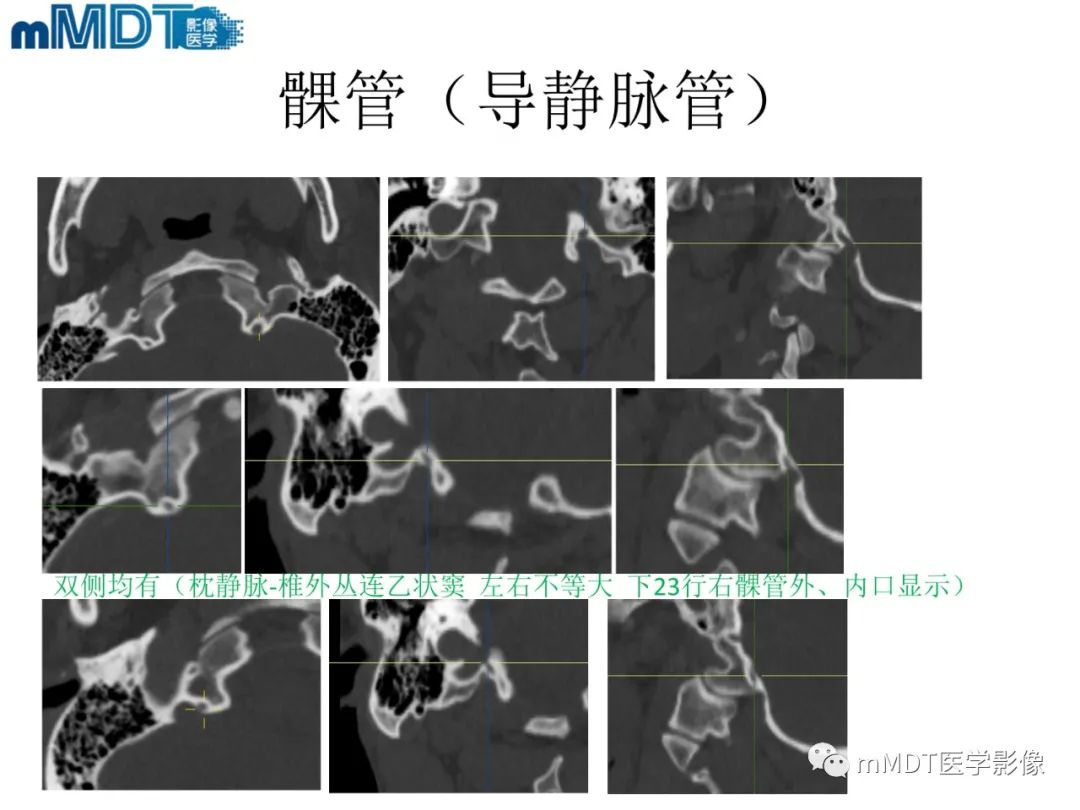 影像PPT - 【PPT】脑神经的影像辨识-82 影像PPT - 【PPT】脑神经的影像辨识-82