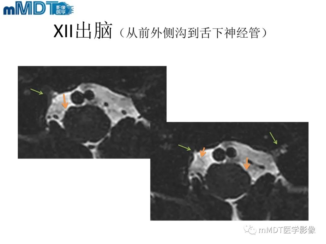 影像PPT - 【PPT】脑神经的影像辨识-84 影像PPT - 【PPT】脑神经的影像辨识-84