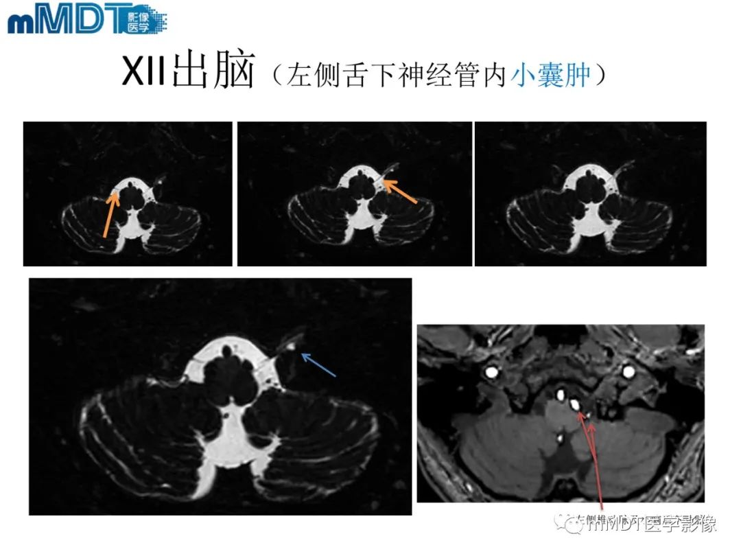 影像PPT - 【PPT】脑神经的影像辨识-85 影像PPT - 【PPT】脑神经的影像辨识-85