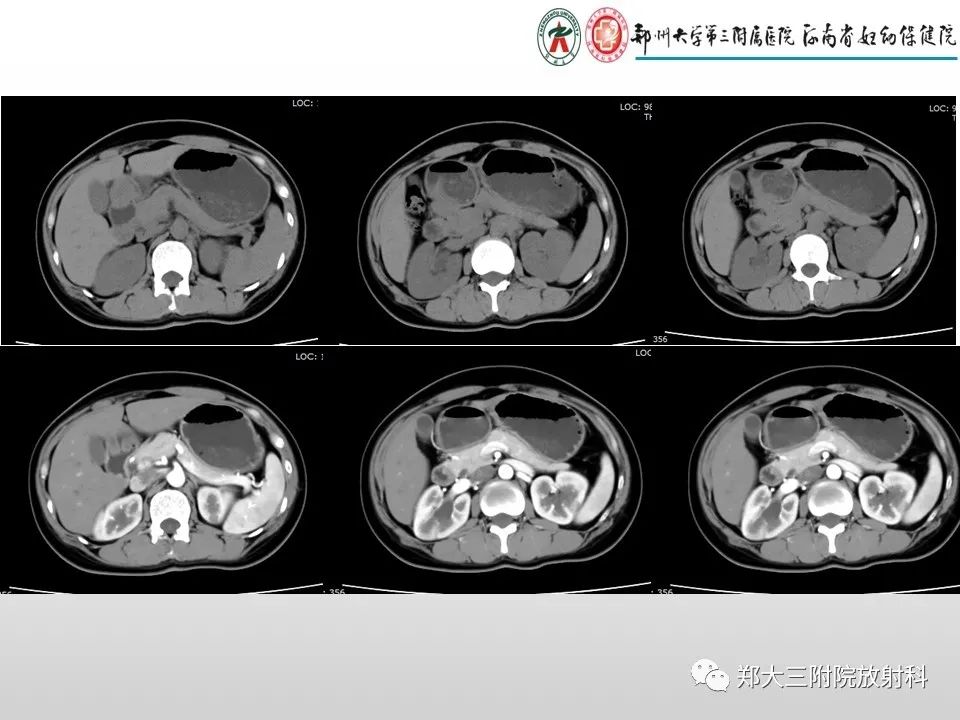 影像PPT - 【PPT】急性肾炎肾炎的影像解读-2