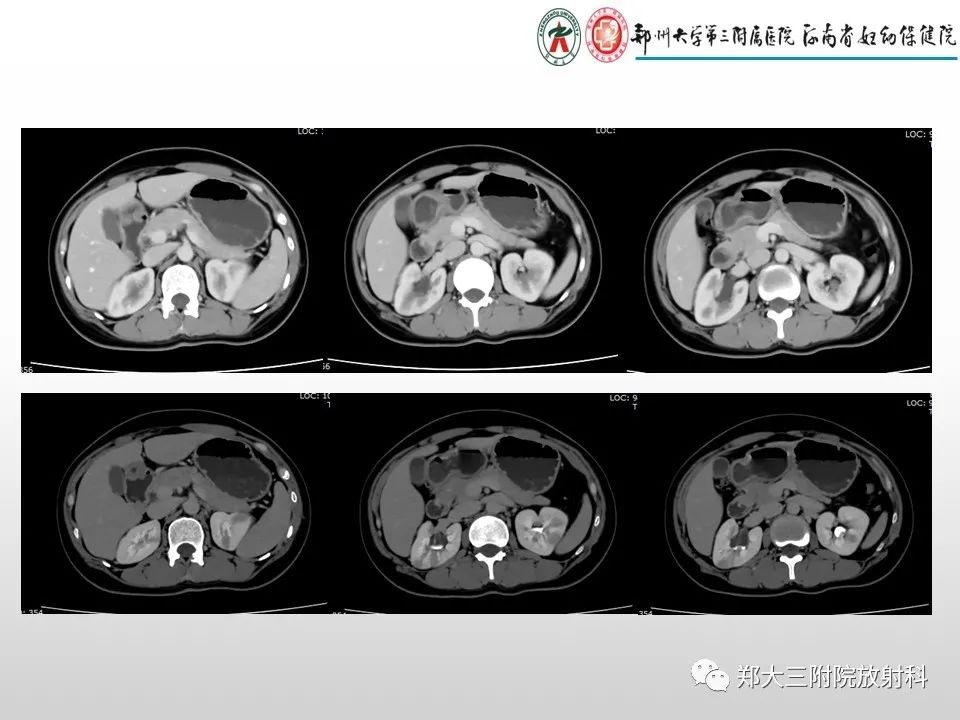 影像PPT - 【PPT】急性肾炎肾炎的影像解读-3