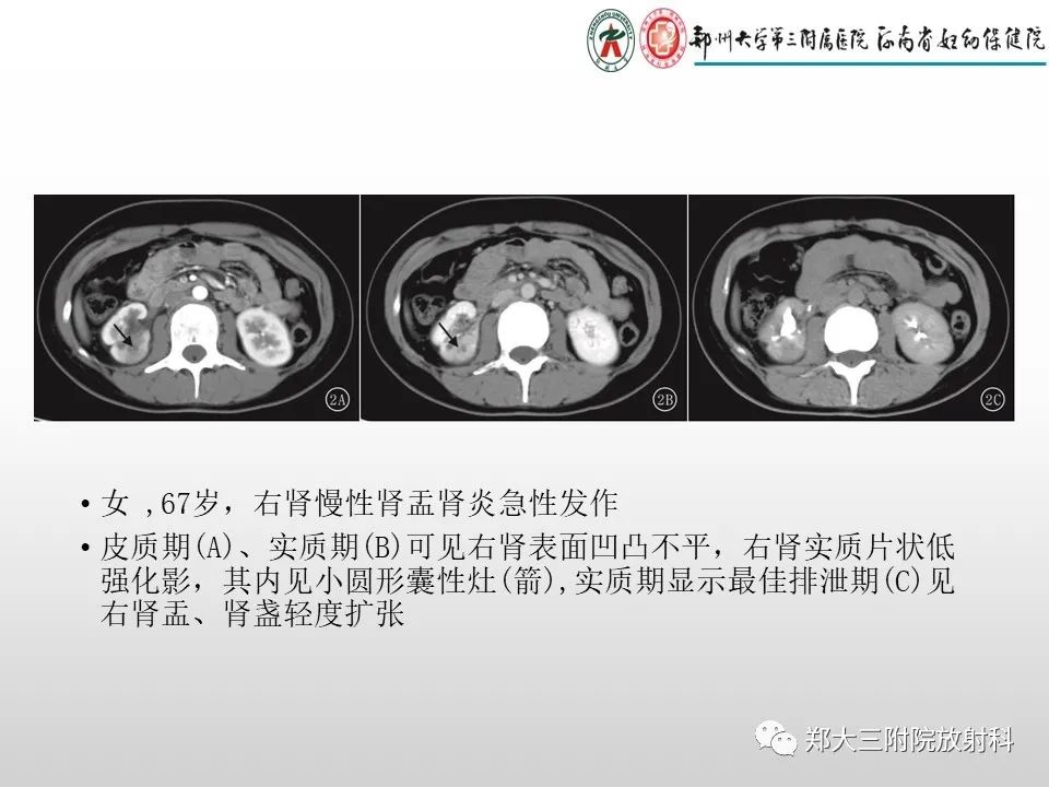 影像PPT - 【PPT】急性肾炎肾炎的影像解读-10