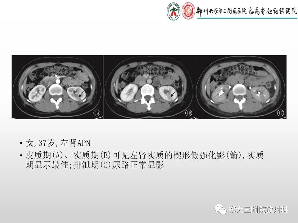 影像PPT - 【PPT】急性肾炎肾炎的影像解读-9