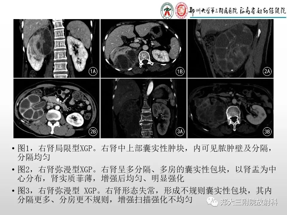 影像PPT - 【PPT】急性肾炎肾炎的影像解读-16