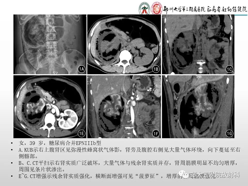 影像PPT - 【PPT】急性肾炎肾炎的影像解读-20