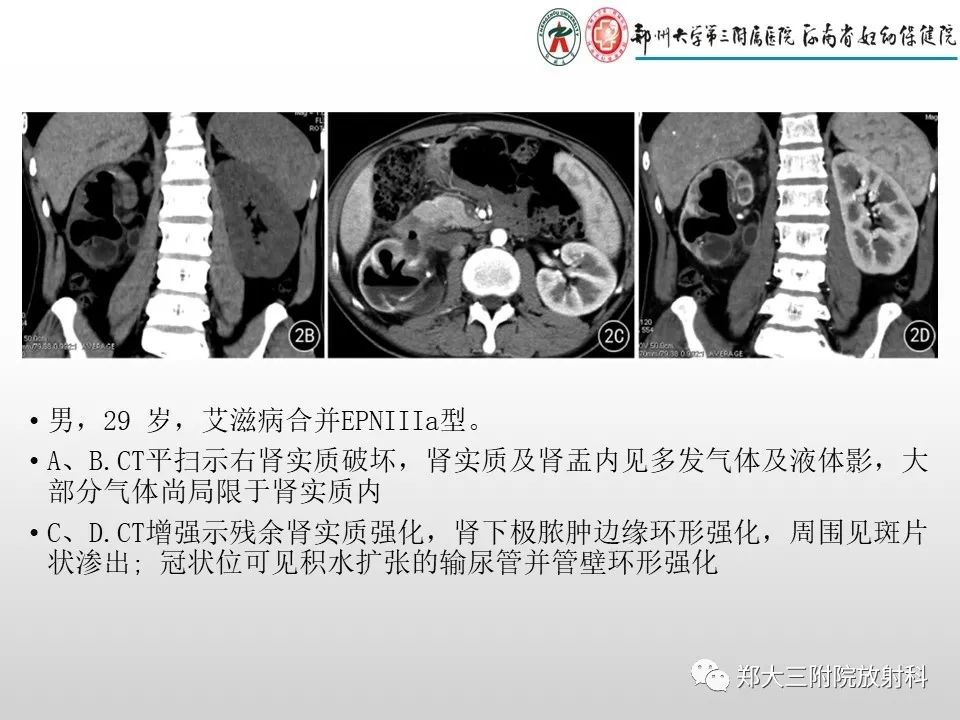 影像PPT - 【PPT】急性肾炎肾炎的影像解读-21
