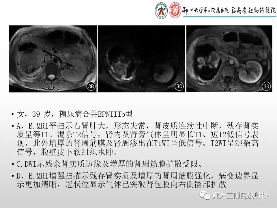 影像PPT - 【PPT】急性肾炎肾炎的影像解读-22