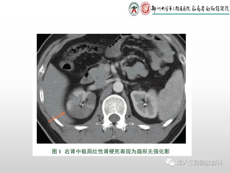 影像PPT - 【PPT】急性肾炎肾炎的影像解读-26