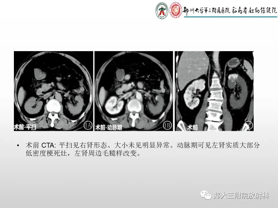 影像PPT - 【PPT】急性肾炎肾炎的影像解读-27