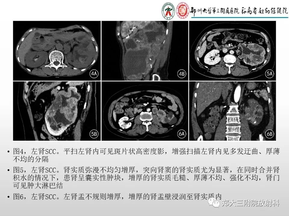 影像PPT - 【PPT】急性肾炎肾炎的影像解读-30