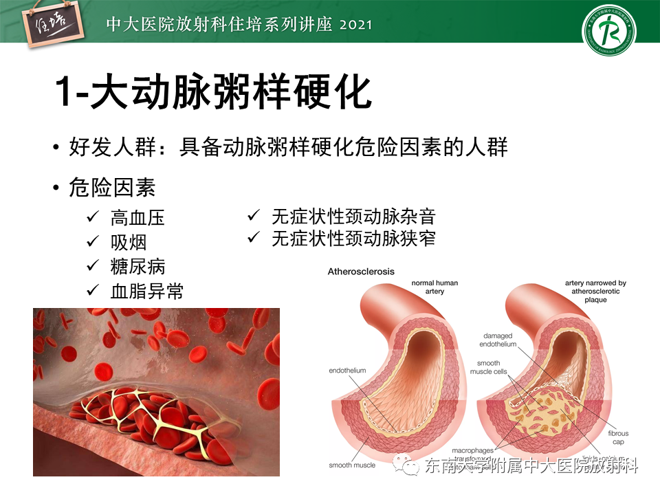 影像PPT - 【PPT】缺血性脑血管病的追根溯源-15