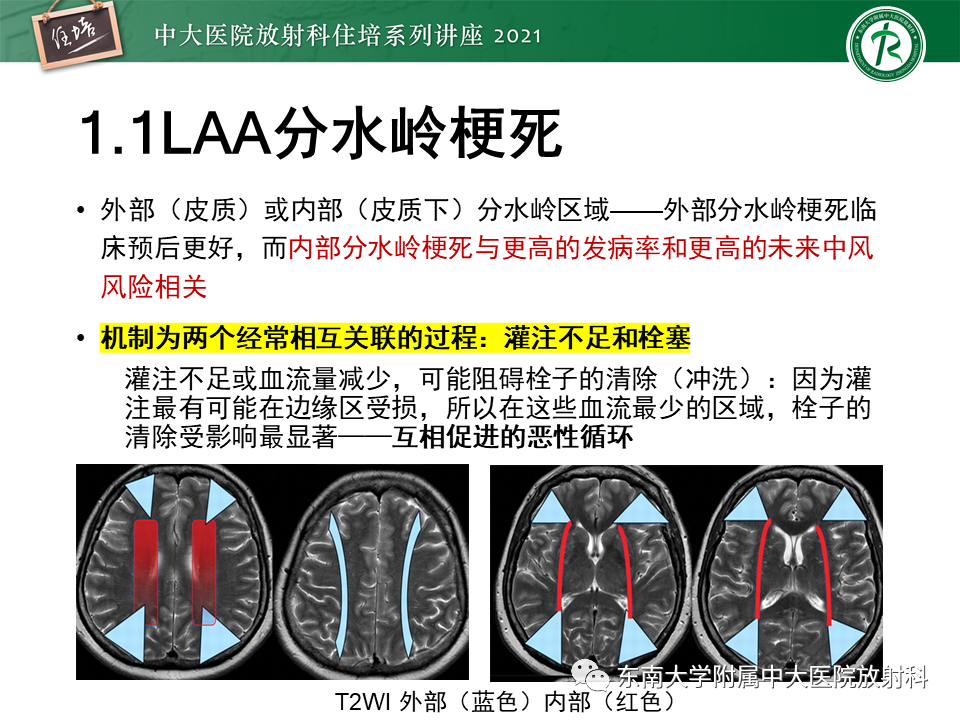 影像PPT - 【PPT】缺血性脑血管病的追根溯源-17