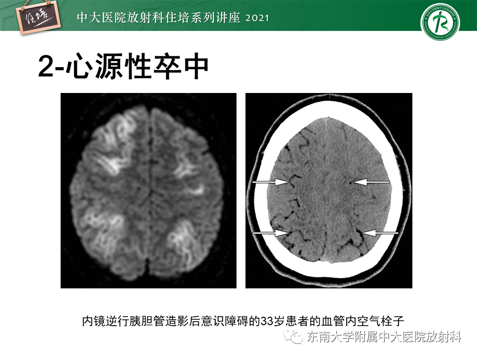 影像PPT - 【PPT】缺血性脑血管病的追根溯源-22
