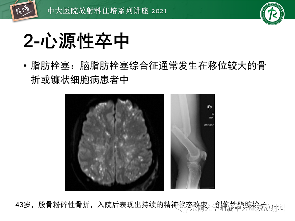 影像PPT - 【PPT】缺血性脑血管病的追根溯源-23