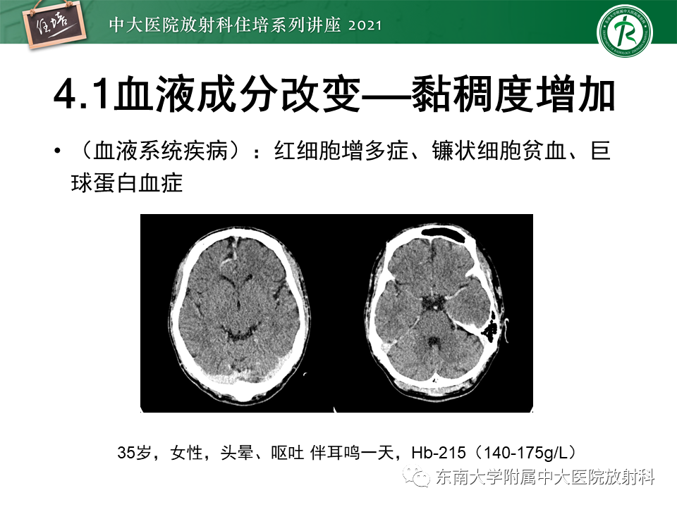 影像PPT - 【PPT】缺血性脑血管病的追根溯源-29