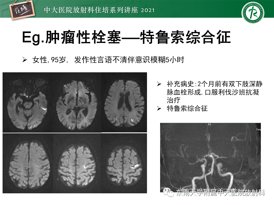影像PPT - 【PPT】缺血性脑血管病的追根溯源-28
