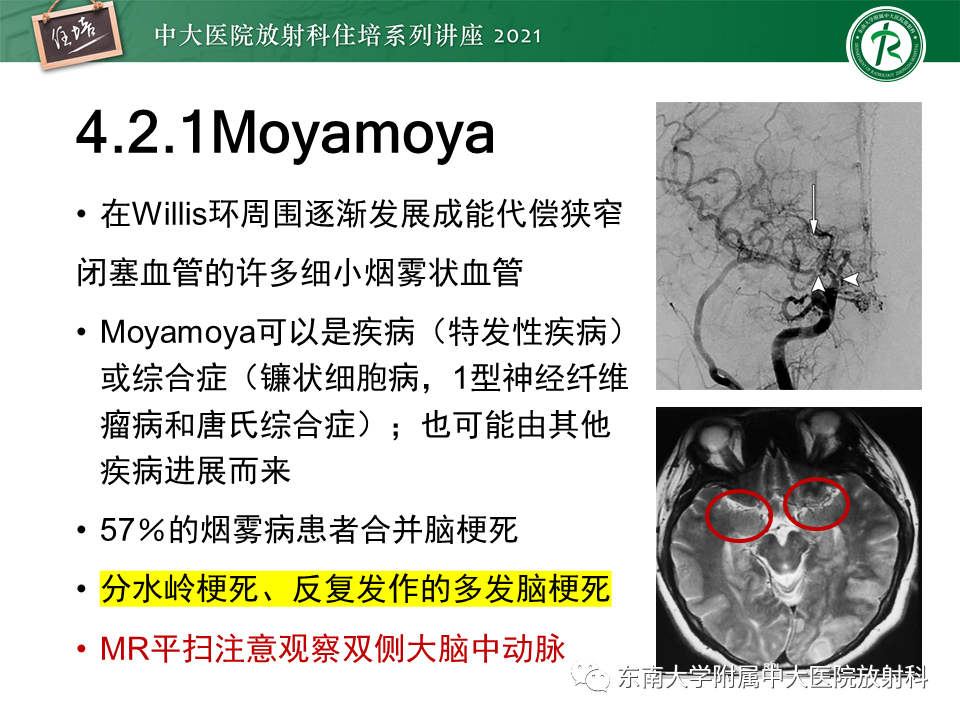 影像PPT - 【PPT】缺血性脑血管病的追根溯源-31