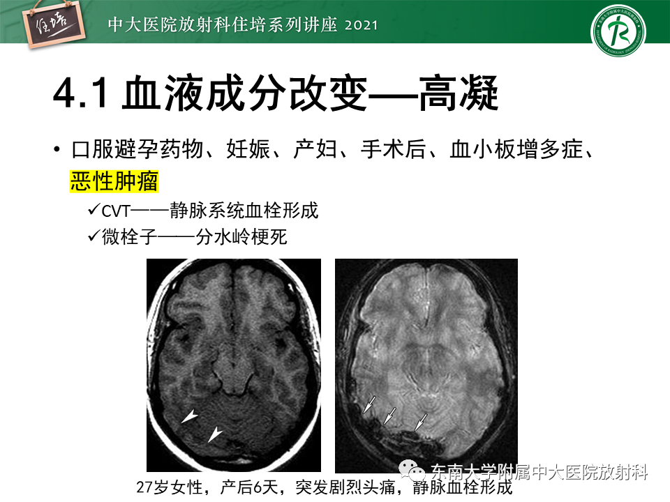 影像PPT - 【PPT】缺血性脑血管病的追根溯源-27