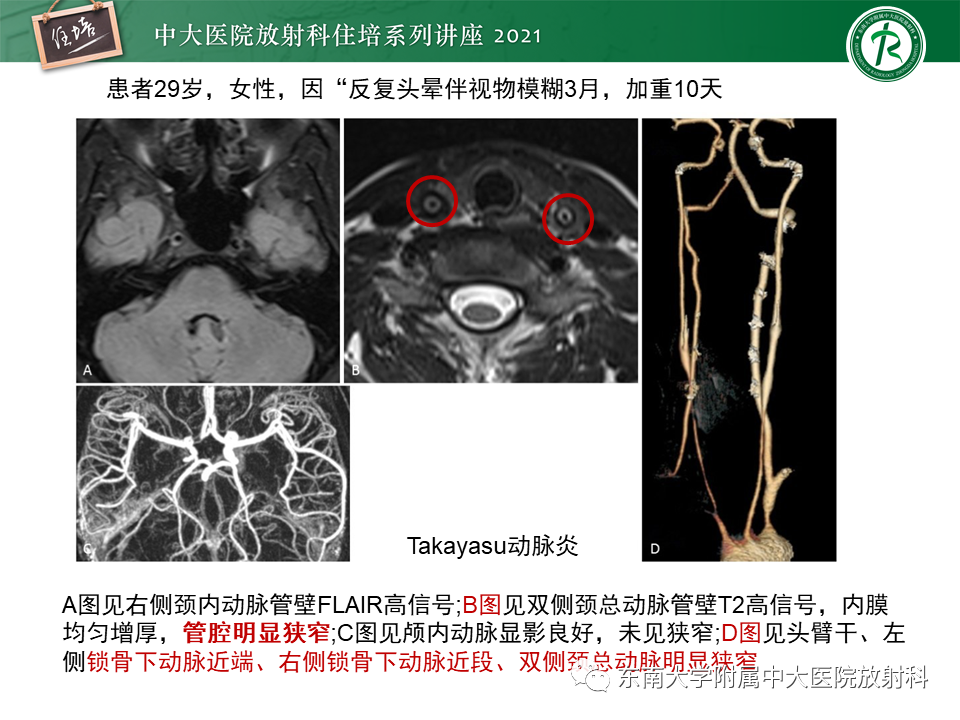 影像PPT - 【PPT】缺血性脑血管病的追根溯源-35
