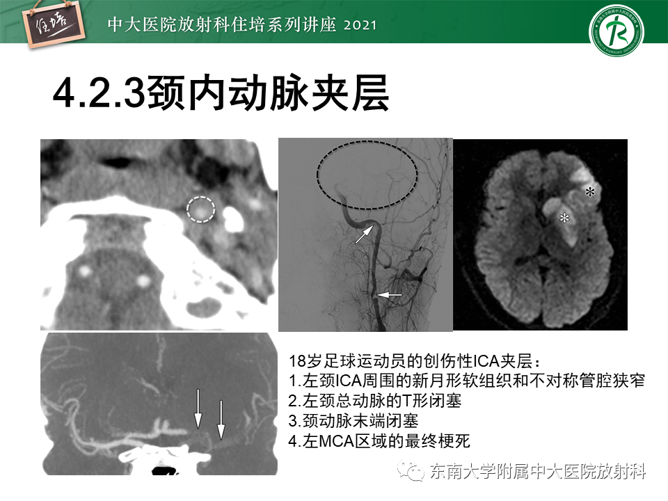 影像PPT - 【PPT】缺血性脑血管病的追根溯源-36