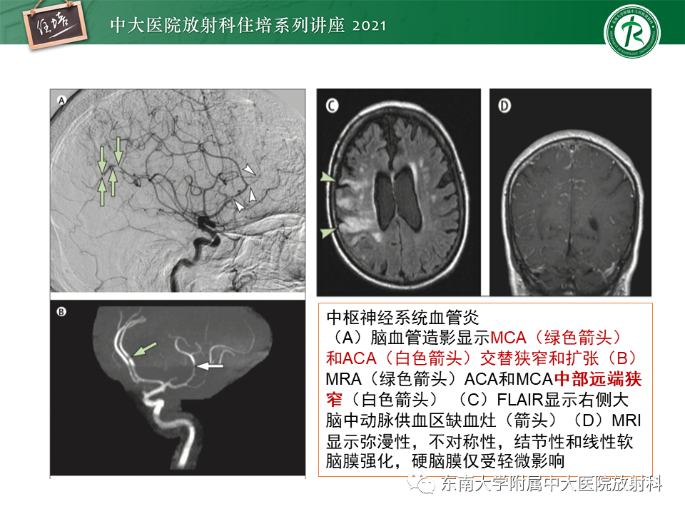 影像PPT - 【PPT】缺血性脑血管病的追根溯源-34