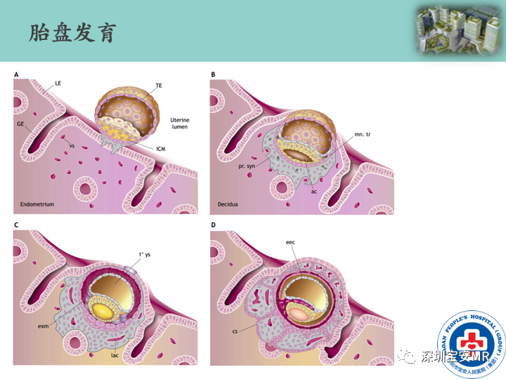 影像PPT - 【PPT】胎盘植入疾病MR评估-4