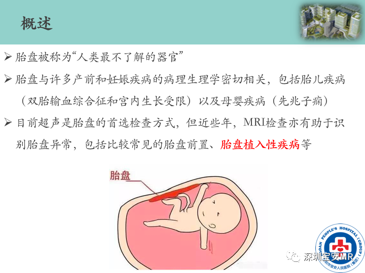 影像PPT - 【PPT】胎盘植入疾病MR评估-3