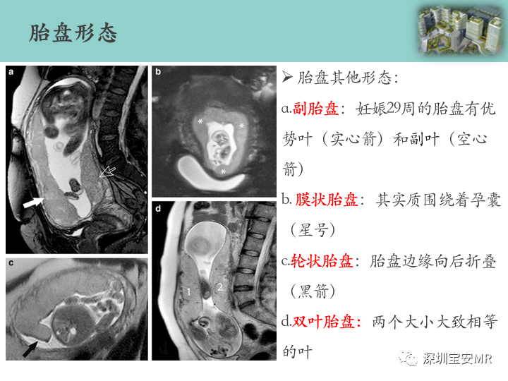 影像PPT - 【PPT】胎盘植入疾病MR评估-12