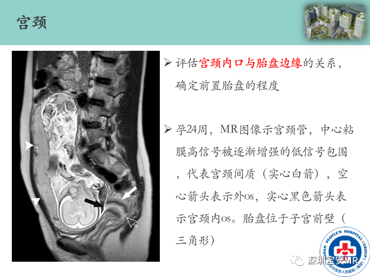 影像PPT - 【PPT】胎盘植入疾病MR评估-10