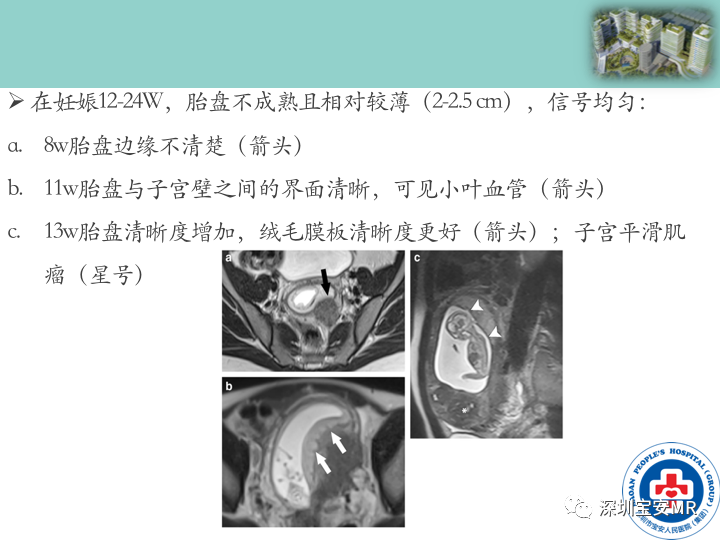 影像PPT - 【PPT】胎盘植入疾病MR评估-14