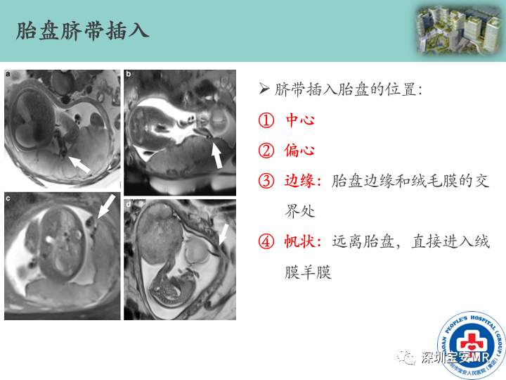 影像PPT - 【PPT】胎盘植入疾病MR评估-11