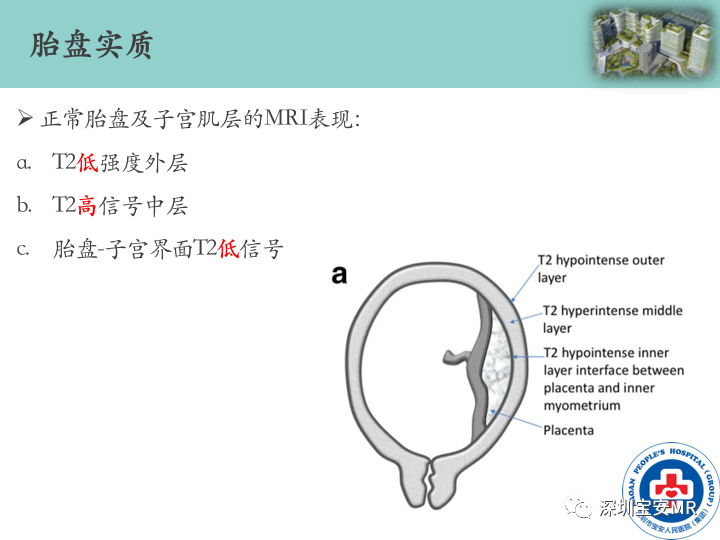 影像PPT - 【PPT】胎盘植入疾病MR评估-13