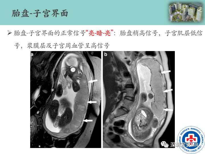 影像PPT - 【PPT】胎盘植入疾病MR评估-17