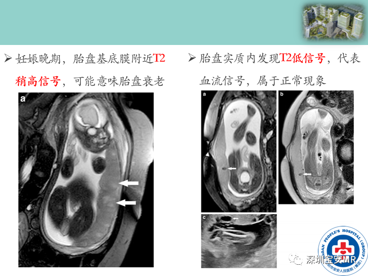 影像PPT - 【PPT】胎盘植入疾病MR评估-16